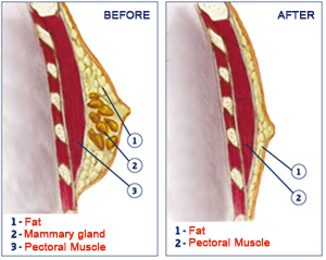 gynecomastia surgery abroad results